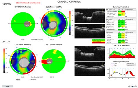 OCT angiography