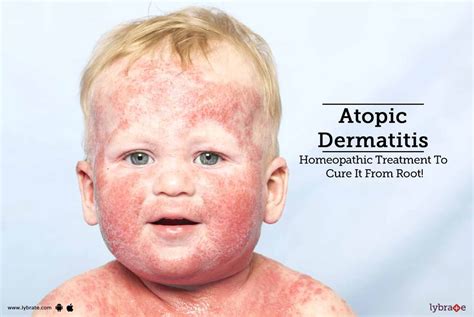 Atopic Dermatitis Homeopathic Treatment To Cure It From Root By Dr