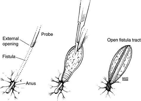 Aga Technical Review On Perianal Crohns Disease Gastroenterology