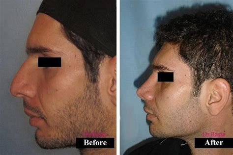 Persian Nose Jobs Before And After Photos 1 Rhinoplasty Cost Pics