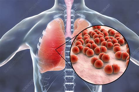 Pneumonia Caused By Streptococcus Pneumoniae Bacteria Conce Stock Image F0221967 Science