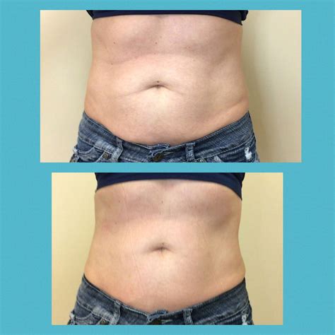 Body Contouring Treatment Body Sculpting Coolsculpt Gilbert AZ