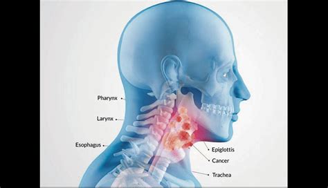 Cancer De Garganta Causas - SEO POSITIVO