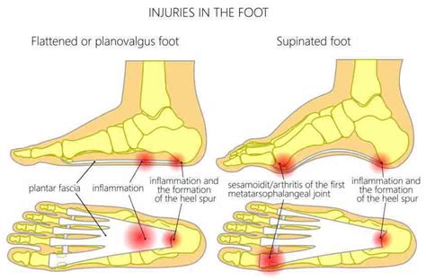 Everything You Need To Know About Cavus Foot