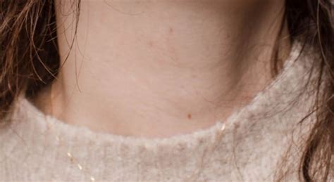 Descubre Por Qu Aparecen Verrugas En El Cuello Tu Piel Y T