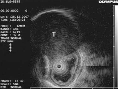 Figure 1 From Surgical Treatment Of Esophageal Leiomyoma Located Near Or At The Esophagogastric