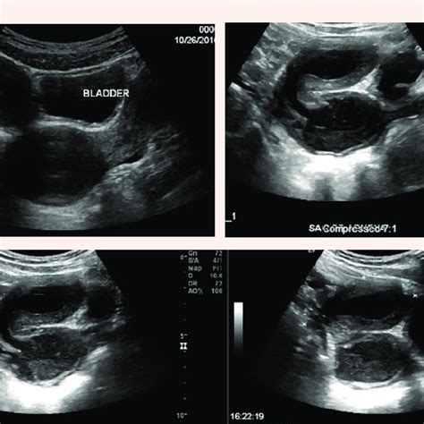 Laparoscopic Fi Nding Shows Uterus Didelphys And Normal Fi Nding Of