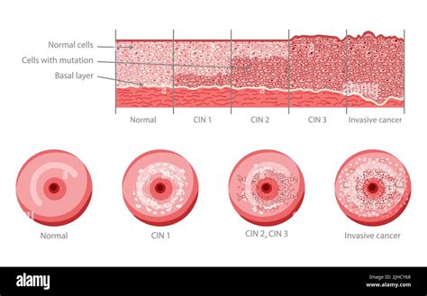 Cervical Invasive Cancer Intraepithelial Neoplasia Dysplasia 1 2 3 And