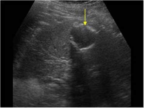 Abdomen and retroperitoneum | 1.4 Spleen : Case 1.4.1 Cysts and ...