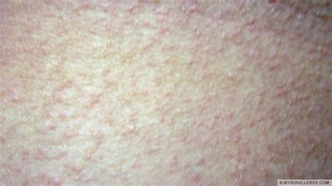 Polymorphous Light Eruption(PMLE) pictures and sun allergy rash images