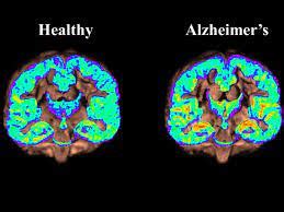 Brain Scan Alzheimer's: A Quick Guide