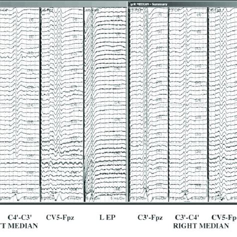 Somatosensory Evoked Potential Ssep Data Stack Showing The Loss Left