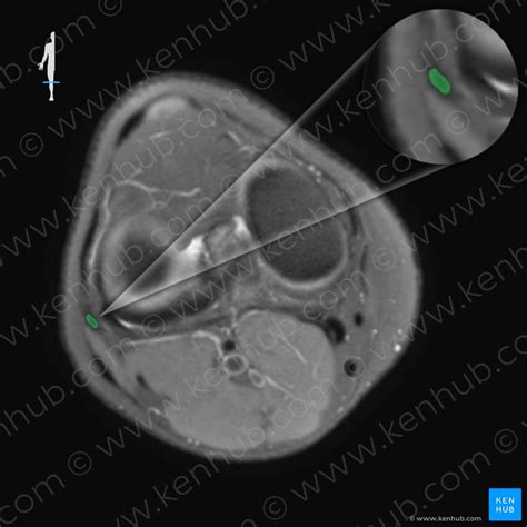 How To Read The Normal Knee Mri Kenhub