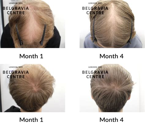 Hair Loss Success Story Saw A Lot Of Progress