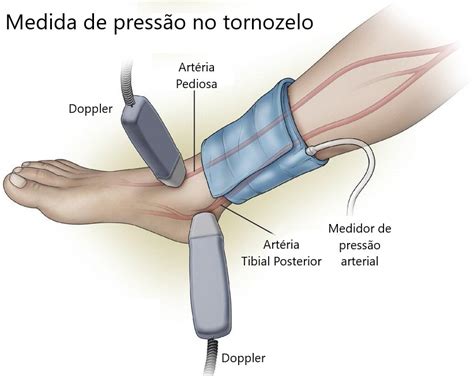 Ndice Tornozelo Bra O Dr Ricardo Lacerda