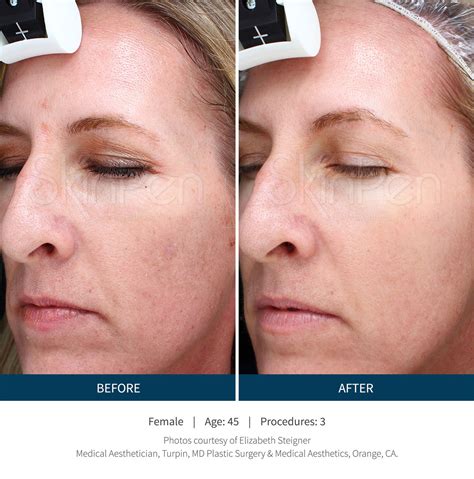 SkinPen Microneedling Before After Photos Vita Aesthetics Wellness