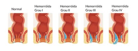 Hemorroidas E Seus Principais Tratamentos Conheça Aqui