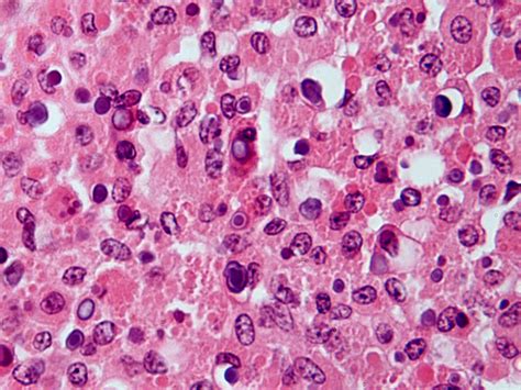 ecthyma gangrenosum - pictures, photos