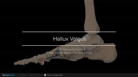 Hallux Valgus Correction With A Ludloff Osteotomy Using A Plantar St