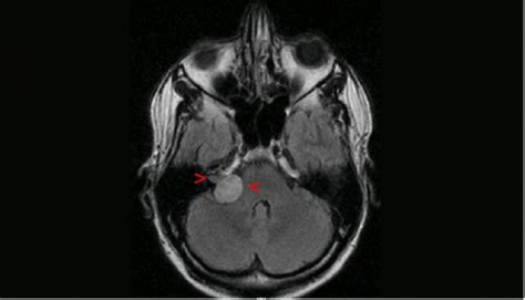 Neurinoma Del Ac Stico