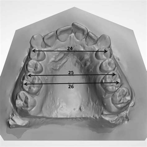 Maxillary Dental Cast Measurements Evaluated In The Present Study