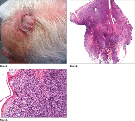 Figure 1 From Rapidly Enlarging Nodule On The Scalp Blastic