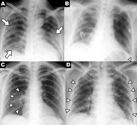 chest x ray findings in covid Covid 19 chest x ray findings — conclusion: in covid-19, cxr shows ...