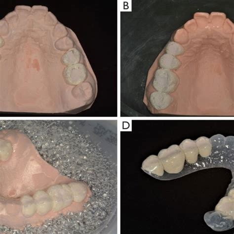 Radiographic Template Fabrication A Maxillary Cast With Artificial