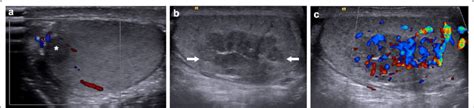 Two Different Patients With Known History Of Congenital Adrenal