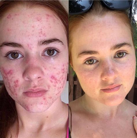 Accutane Before And After Cystic Acne