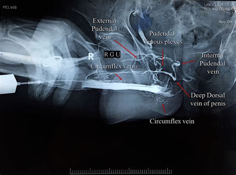 Urethro Venous Intravasation A Rare Complication Of Retrograde