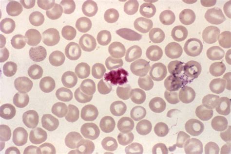 Platelets On Blood Smear