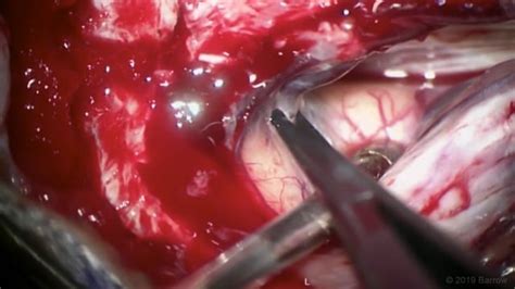 Interhemispheric Contralateral Craniotomy For Meningioma Tumor The