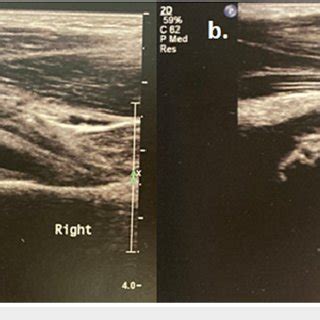 a) Right hip ultrasound demonstrating joint effusion (3.14 mm) (white... | Download Scientific ...