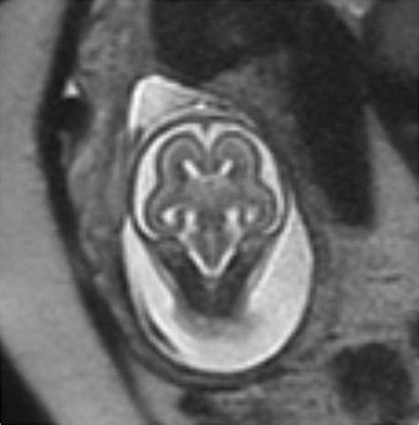 Complete anotia is depicted on coronal T2-W MR image in this 21-week... | Download Scientific ...