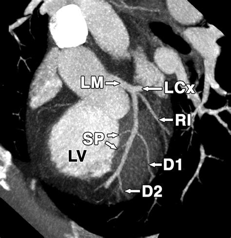 Normal And Variant Coronary Arterial And Venous Anatomy On High