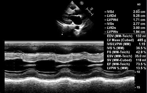 What Is Lvidd On Echocardiogram