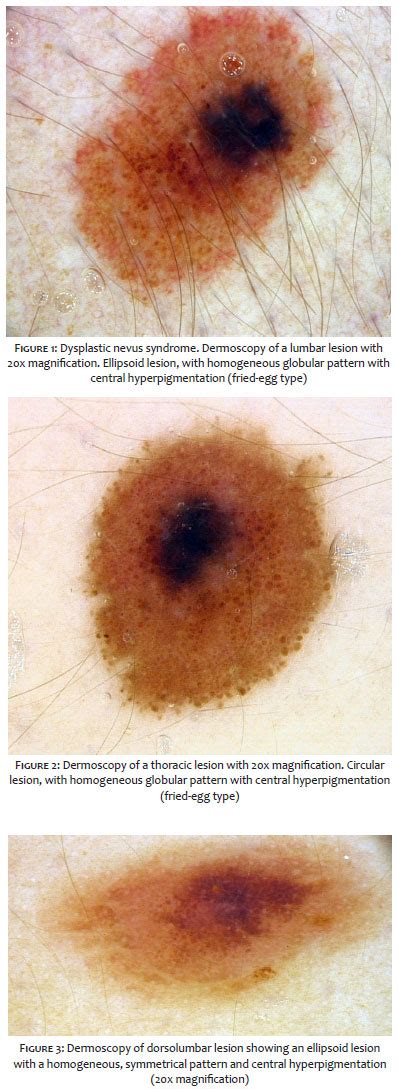 Surgical And Cosmetic Dermatology Infantile Melanoma Early Diagnosis