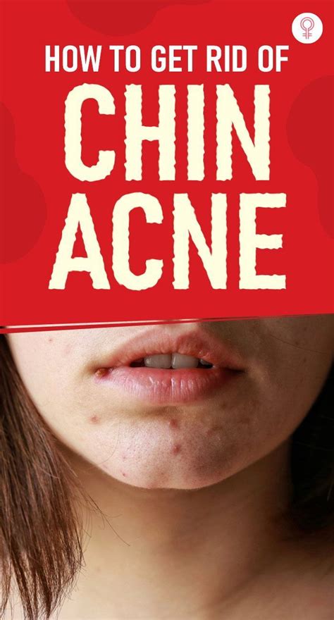 Chin Acne Pimples Causes Treatment And Skin Care Tips Artofit