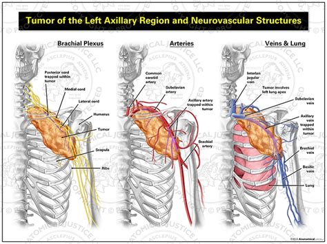 Tumor of the Left Axillary Region and Neurovascular Structures