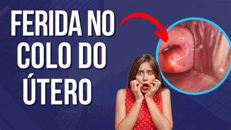 Ferida No Utero O Que Causa - Causas de Feridas no Útero: O Que Você Precisa Saber | Actualizado ...