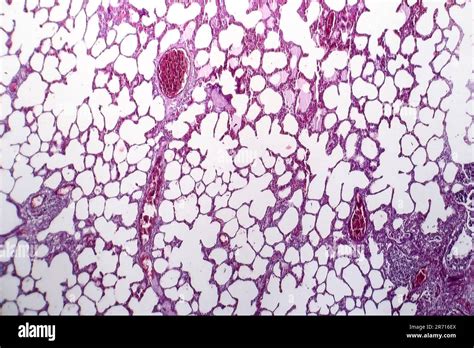 Histopathology Of Pneumonia Light Micrograph Photo Under Microscope