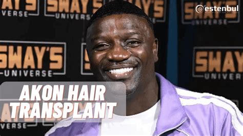 Akon Spent Dollars On Hair Transplant In Turkey Estenbul Health