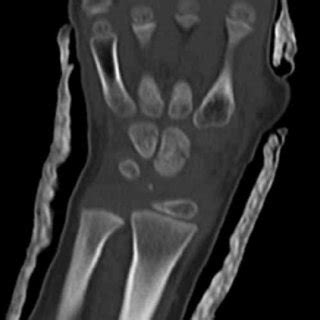 Coronal Computed Tomography Scan Showing Fractures Of The Capitate And