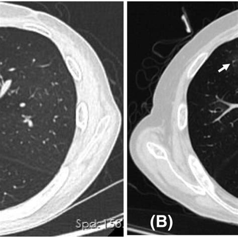 A Case 1 High‐resolution Computed Tomography Hrct Showed Mild