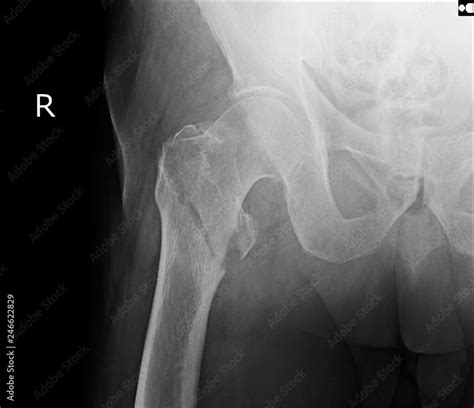 Hip fracture xray photo image. X-ray of hip joint for elderly patient ...