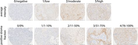 Ihc Staining And Scoring Of Pdgfrb Example Pictures Of Pdgfrb