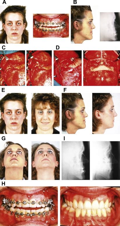 Craniofacial Dysostosis Syndromes Evaluation And Staged Reconstructive