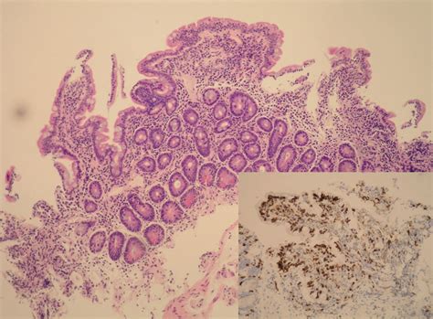 Duodenal Mucosa Partial Villous Atrophy Increased Inflammatory