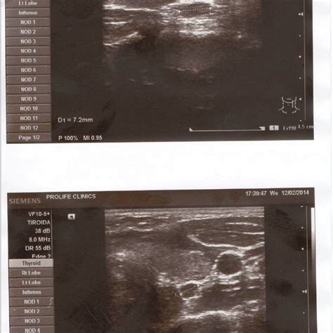 Ultrasound-parathyroid adenoma (arrow); normal aspect of thyroid gland ...